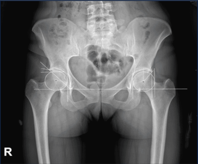 An anteroposterior pelvic radiograph with the femoral heads and the measurement baseline marked